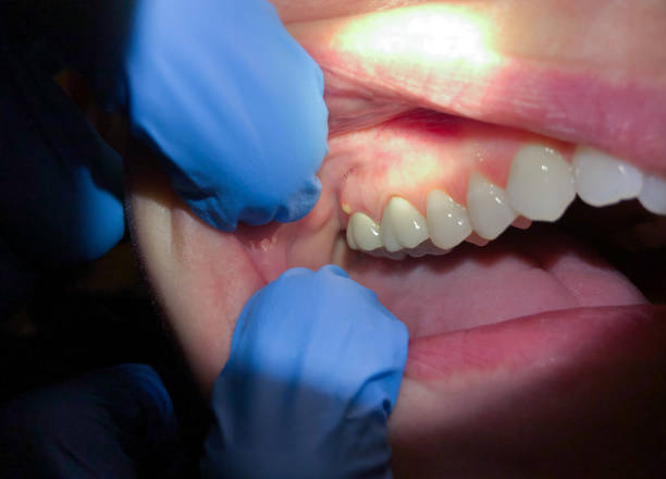 Best Emergency Wisdom Tooth Extraction in Falls City, NE
